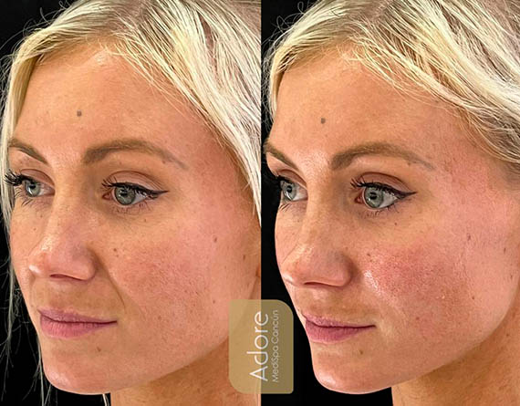 Liquid Facelift in Cancun