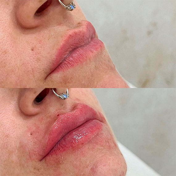 Lip Fillers in Cancun