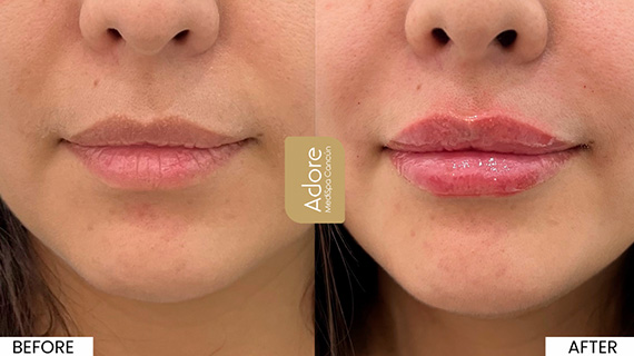 Lip Fillers in Cancun