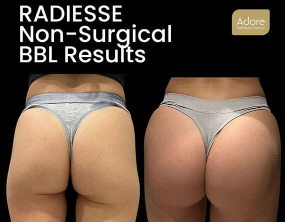 Hyperdilute Radiesse Treatment Areas